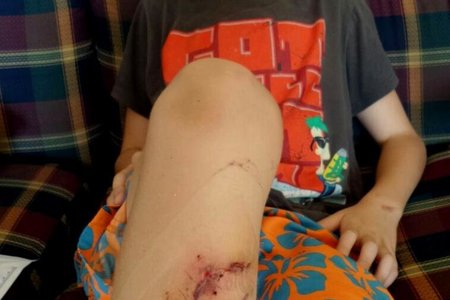 Leo Lotz met die ernstige wond wat hy aan sy been opgedoen het tydens sy heldhaftige optrede